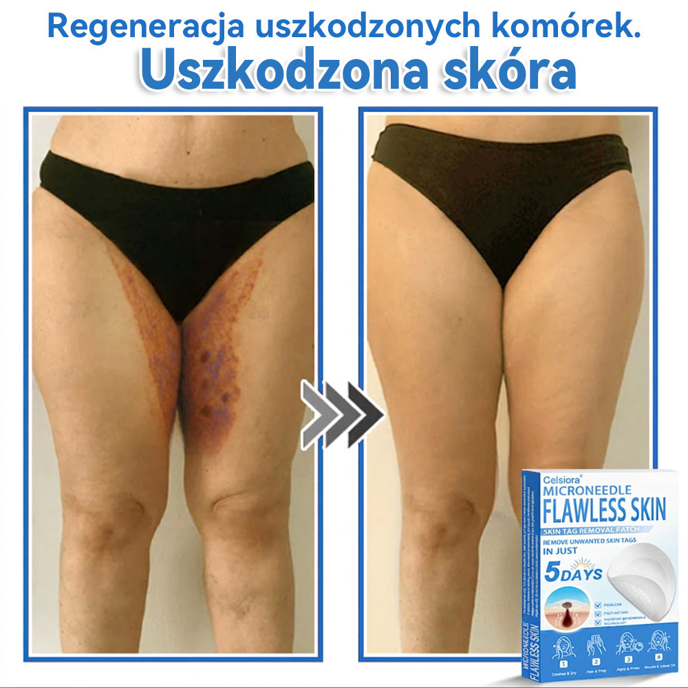 Celsiora® 2 w 1 – mikronakłuwające i hydrożelowe plastry na znamiona, trądzik i niedoskonałości skóry🎁