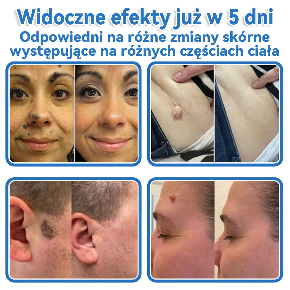Celsiora® 2 w 1 – mikronakłuwające i hydrożelowe plastry na znamiona, trądzik i niedoskonałości skóry🎁