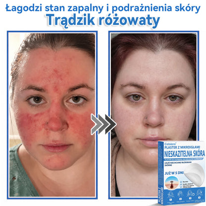 Celsiora® 2 w 1 – mikronakłuwające i hydrożelowe plastry na znamiona, trądzik i niedoskonałości skóry🎁