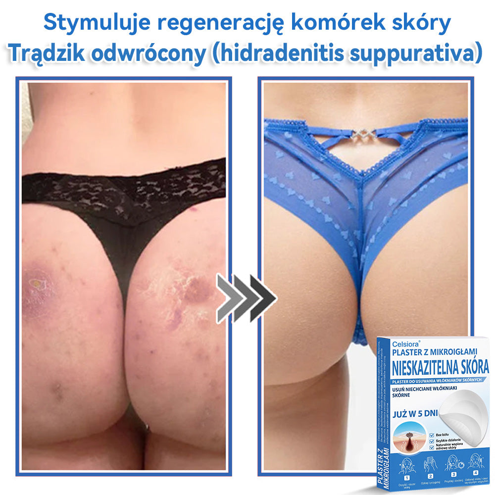 Celsiora® 2 w 1 – mikronakłuwające i hydrożelowe plastry na znamiona, trądzik i niedoskonałości skóry🎁