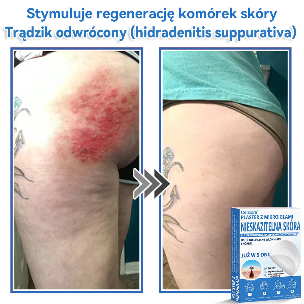 Celsiora® 2 w 1 – mikronakłuwające i hydrożelowe plastry na znamiona, trądzik i niedoskonałości skóry🎁