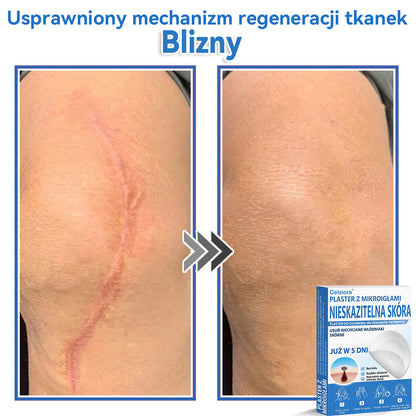 Celsiora® 2 w 1 – mikronakłuwające i hydrożelowe plastry na znamiona, trądzik i niedoskonałości skóry🎁