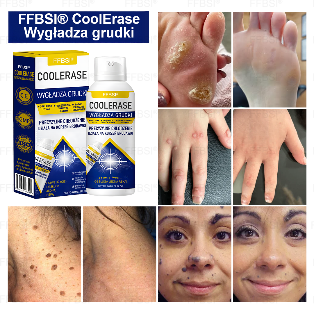 FFBSI®  CoolErase Spray do regeneracji skóry☘️(Brodawe, Pęcherze, Wypryski, Łuszczyca, Zmiany skórne, Trądzik, Skórne narośle, Blizny, Pieprzyki)