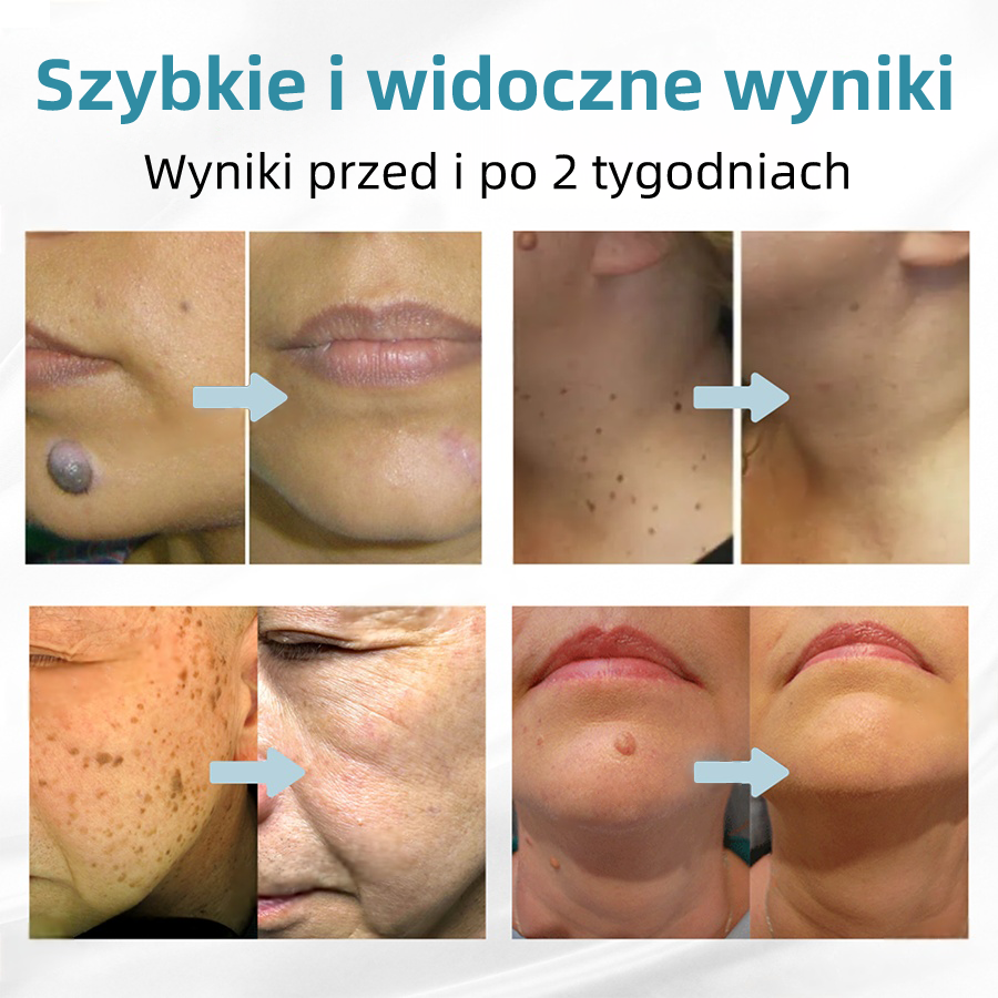 𝐾𝑖𝑑𝑠𝑛𝑒𝑒𝑑®𝐵𝑒𝑧𝑖𝑛𝑤𝑎𝑧𝑦𝑗𝑛𝑦 𝑑ł𝑢𝑔𝑜𝑝𝑖𝑠 𝑙𝑎𝑠𝑒𝑟𝑜𝑤𝑦 𝑑𝑜 𝑢𝑠𝑢𝑤𝑎𝑛𝑖𝑎 𝑧𝑛𝑎𝑚𝑖𝑜𝑛 (𝑠𝑧𝑦𝑏𝑘𝑖𝑒, 𝑏𝑒𝑧𝑏𝑜𝑙𝑒𝑠𝑛𝑒 𝑢𝑠𝑢𝑤𝑎𝑛𝑖𝑒 𝑏𝑟𝑜𝑑𝑎𝑤𝑒𝑘, 𝑧𝑛𝑎𝑚𝑖𝑜𝑛, 𝑝𝑙𝑎𝑚 𝑠𝑡𝑎𝑟𝑐𝑧𝑦𝑐ℎ 𝑖 𝑧𝑛𝑎𝑐𝑧𝑛𝑖𝑘ó𝑤 𝑠𝑘ó𝑟𝑛𝑦𝑐ℎ, 𝑏𝑒𝑧 𝑠𝑘𝑢𝑡𝑘ó𝑤 𝑢𝑏𝑜𝑐𝑧𝑛𝑦𝑐ℎ) 💖