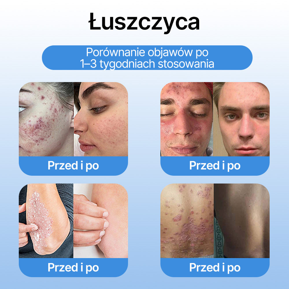 𝗹𝘂𝙠𝙢𝙡𝙘𝙖® 𝑪𝒐𝒐𝒍𝑬𝒓𝒂𝒔𝒆 𝑺𝒑𝒓𝒂𝒚 𝒅𝒐 𝒓𝒆𝒈𝒆𝒏𝒆𝒓𝒂𝒄𝒋𝒊 𝒔𝒌ó𝒓𝒚 🌿(𝑏𝑟𝑜𝑑𝑎𝑤𝑘𝑖, 𝑝ę𝑐ℎ𝑒𝑟𝑧𝑒, 𝑤𝑦𝑠𝑦𝑝𝑘𝑖, ł𝑢𝑠𝑧𝑐𝑧𝑦𝑐𝑎, 𝑝𝑟𝑜𝑏𝑙𝑒𝑚𝑦 𝑠𝑘ó𝑟𝑛𝑒, 𝑡𝑟ą𝑑𝑧𝑖𝑘, 𝑛𝑎𝑟𝑜ś𝑙𝑎 𝑠𝑘ó𝑟𝑛𝑒, 𝑏𝑙𝑖𝑧𝑛𝑦, 𝑧𝑛𝑎𝑚𝑖𝑜𝑛𝑎)🔥