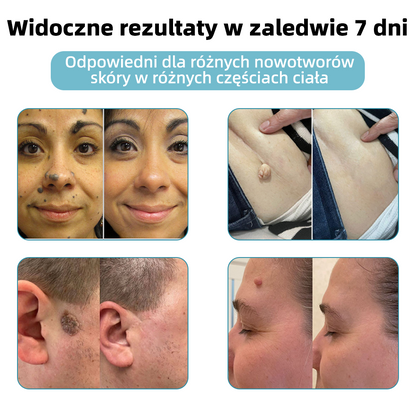 𝐾𝑖𝑑𝑠𝑛𝑒𝑒𝑑®𝐵𝑒𝑧𝑖𝑛𝑤𝑎𝑧𝑦𝑗𝑛𝑦 𝑑ł𝑢𝑔𝑜𝑝𝑖𝑠 𝑙𝑎𝑠𝑒𝑟𝑜𝑤𝑦 𝑑𝑜 𝑢𝑠𝑢𝑤𝑎𝑛𝑖𝑎 𝑧𝑛𝑎𝑚𝑖𝑜𝑛 (𝑠𝑧𝑦𝑏𝑘𝑖𝑒, 𝑏𝑒𝑧𝑏𝑜𝑙𝑒𝑠𝑛𝑒 𝑢𝑠𝑢𝑤𝑎𝑛𝑖𝑒 𝑏𝑟𝑜𝑑𝑎𝑤𝑒𝑘, 𝑧𝑛𝑎𝑚𝑖𝑜𝑛, 𝑝𝑙𝑎𝑚 𝑠𝑡𝑎𝑟𝑐𝑧𝑦𝑐ℎ 𝑖 𝑧𝑛𝑎𝑐𝑧𝑛𝑖𝑘ó𝑤 𝑠𝑘ó𝑟𝑛𝑦𝑐ℎ, 𝑏𝑒𝑧 𝑠𝑘𝑢𝑡𝑘ó𝑤 𝑢𝑏𝑜𝑐𝑧𝑛𝑦𝑐ℎ) 💖