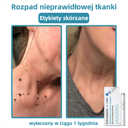 𝐾𝑖𝑑𝑠𝑛𝑒𝑒𝑑®𝐵𝑒𝑧𝑖𝑛𝑤𝑎𝑧𝑦𝑗𝑛𝑦 𝑑ł𝑢𝑔𝑜𝑝𝑖𝑠 𝑙𝑎𝑠𝑒𝑟𝑜𝑤𝑦 𝑑𝑜 𝑢𝑠𝑢𝑤𝑎𝑛𝑖𝑎 𝑧𝑛𝑎𝑚𝑖𝑜𝑛 (𝑠𝑧𝑦𝑏𝑘𝑖𝑒, 𝑏𝑒𝑧𝑏𝑜𝑙𝑒𝑠𝑛𝑒 𝑢𝑠𝑢𝑤𝑎𝑛𝑖𝑒 𝑏𝑟𝑜𝑑𝑎𝑤𝑒𝑘, 𝑧𝑛𝑎𝑚𝑖𝑜𝑛, 𝑝𝑙𝑎𝑚 𝑠𝑡𝑎𝑟𝑐𝑧𝑦𝑐ℎ 𝑖 𝑧𝑛𝑎𝑐𝑧𝑛𝑖𝑘ó𝑤 𝑠𝑘ó𝑟𝑛𝑦𝑐ℎ, 𝑏𝑒𝑧 𝑠𝑘𝑢𝑡𝑘ó𝑤 𝑢𝑏𝑜𝑐𝑧𝑛𝑦𝑐ℎ) 💖