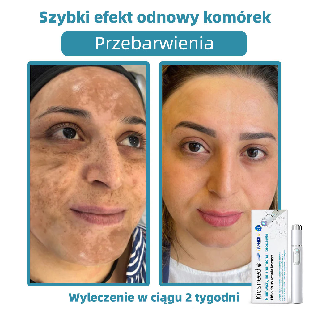 𝐾𝑖𝑑𝑠𝑛𝑒𝑒𝑑®𝐵𝑒𝑧𝑖𝑛𝑤𝑎𝑧𝑦𝑗𝑛𝑦 𝑑ł𝑢𝑔𝑜𝑝𝑖𝑠 𝑙𝑎𝑠𝑒𝑟𝑜𝑤𝑦 𝑑𝑜 𝑢𝑠𝑢𝑤𝑎𝑛𝑖𝑎 𝑧𝑛𝑎𝑚𝑖𝑜𝑛 (𝑠𝑧𝑦𝑏𝑘𝑖𝑒, 𝑏𝑒𝑧𝑏𝑜𝑙𝑒𝑠𝑛𝑒 𝑢𝑠𝑢𝑤𝑎𝑛𝑖𝑒 𝑏𝑟𝑜𝑑𝑎𝑤𝑒𝑘, 𝑧𝑛𝑎𝑚𝑖𝑜𝑛, 𝑝𝑙𝑎𝑚 𝑠𝑡𝑎𝑟𝑐𝑧𝑦𝑐ℎ 𝑖 𝑧𝑛𝑎𝑐𝑧𝑛𝑖𝑘ó𝑤 𝑠𝑘ó𝑟𝑛𝑦𝑐ℎ, 𝑏𝑒𝑧 𝑠𝑘𝑢𝑡𝑘ó𝑤 𝑢𝑏𝑜𝑐𝑧𝑛𝑦𝑐ℎ) 💖