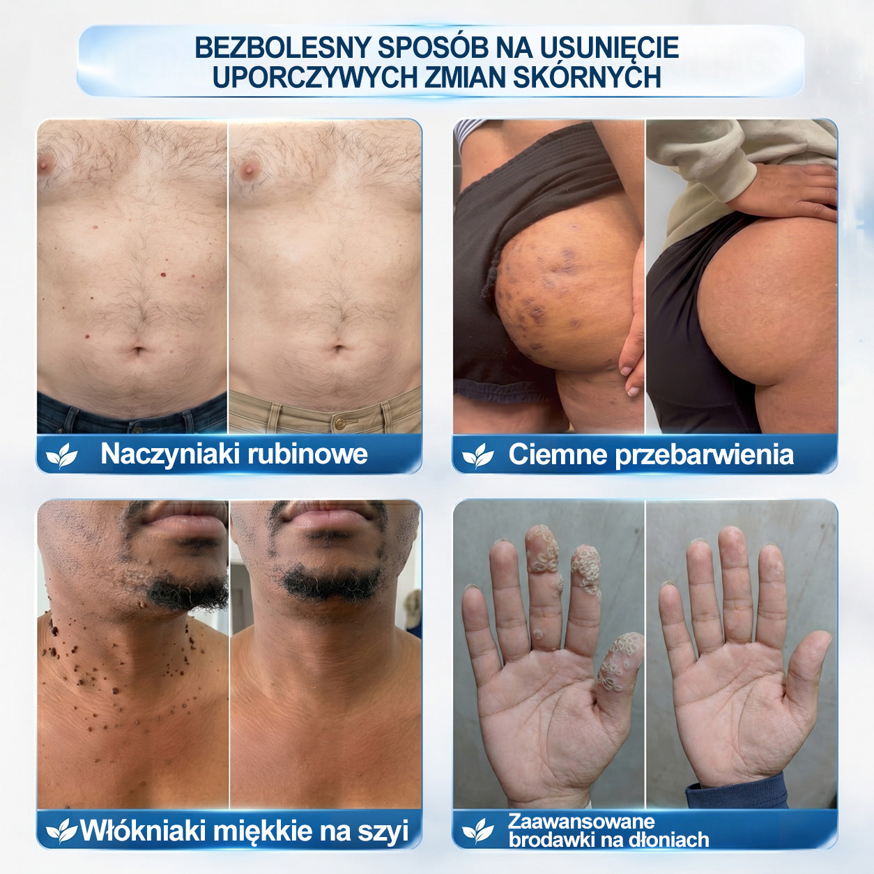 Oficjalny Sklep Markowy | ✅👩‍⚕️ 𝐏i𝐜𝐝o® 7-Dniowy 𝗧𝗮𝗴 & 𝗦𝗽𝗼𝐭 𝐄𝐫𝐚𝐬𝐞𝐫 (Bez bólu, Bez blizn – aplikator z kulką) 🎉