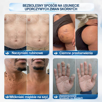Oficjalny Sklep Markowy | ✅👩‍⚕️ 𝐏i𝐜𝐝o® 7-Dniowy 𝗧𝗮𝗴 & 𝗦𝗽𝗼𝐭 𝐄𝐫𝐚𝐬𝐞𝐫 (Bez bólu, Bez blizn – aplikator z kulką) 🎉