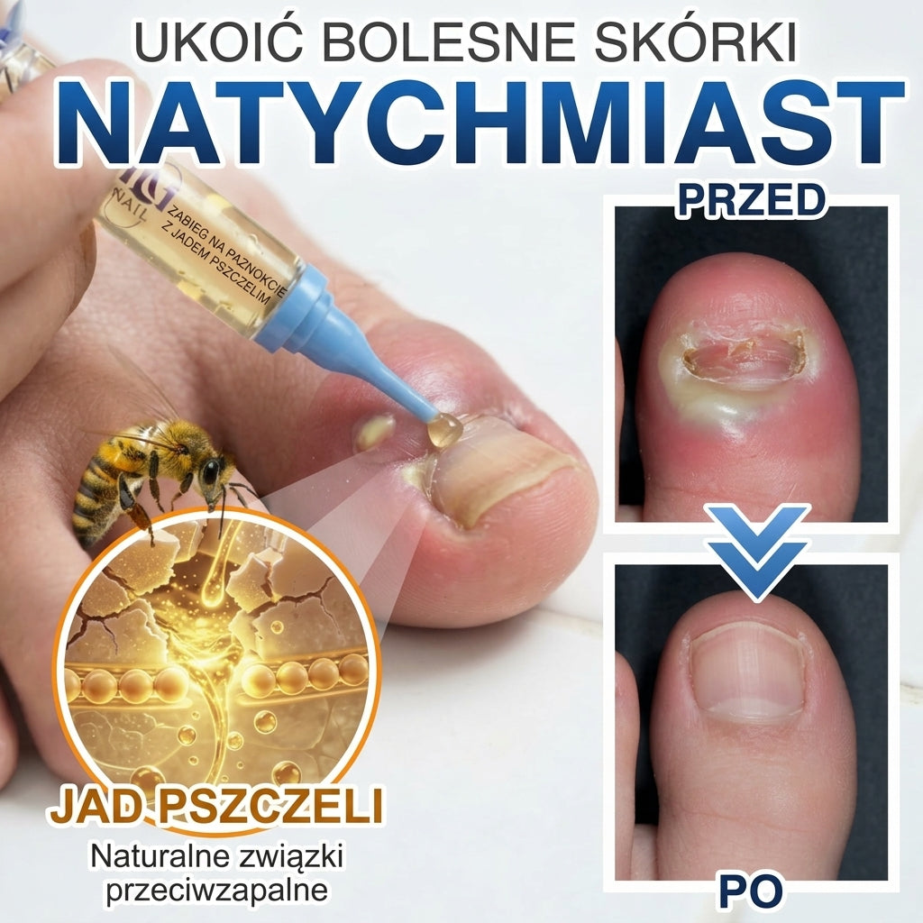 🇵🇱 CareBreeze® Fungi Free – kuracja na paznokcie na bazie jadu pszczelego 🌿1