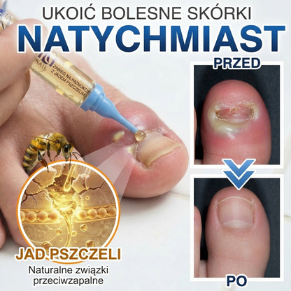 🇵🇱 CareBreeze® Fungi Free – kuracja na paznokcie na bazie jadu pszczelego 🌿1