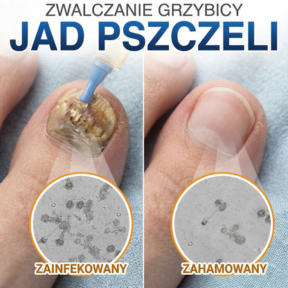 🇵🇱 CareBreeze® Fungi Free – kuracja na paznokcie na bazie jadu pszczelego 🌿1